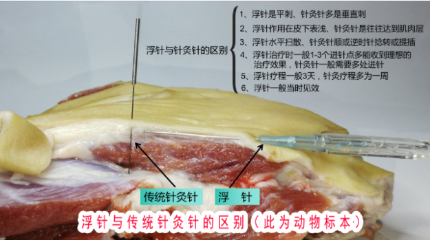 浮针和针灸针以及针刀的区别
