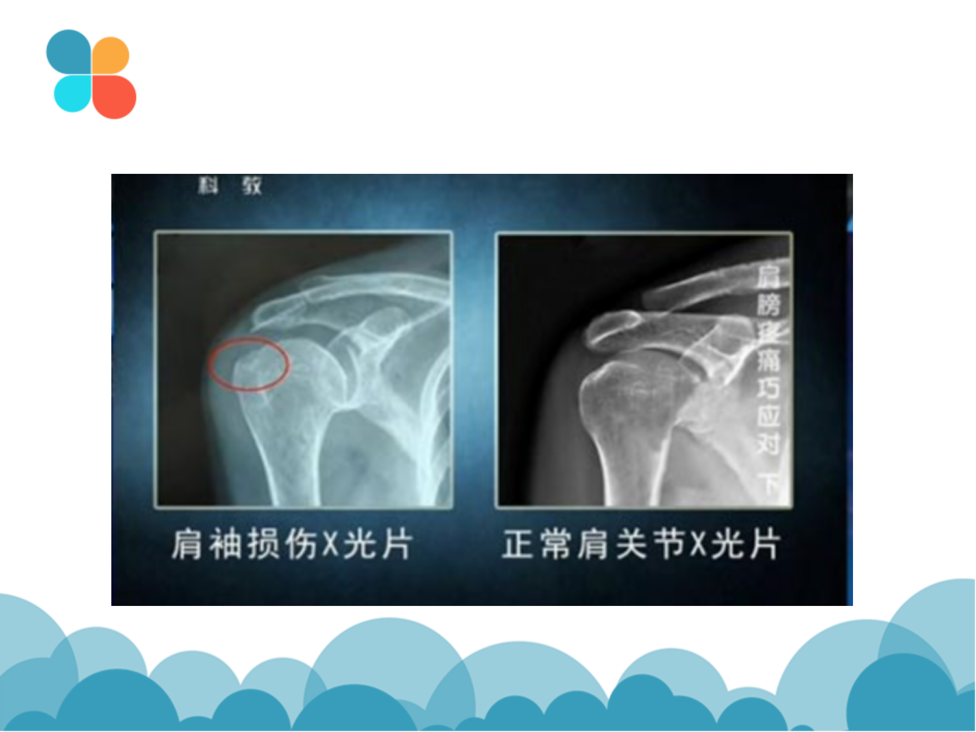 肩袖解剖LY_28.png